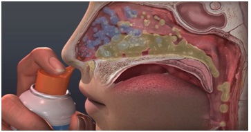 Gambar. 1 Cara melalukan cuci hidung