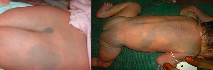 Mongolian spots