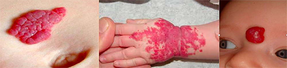 Strawberry Hemangioma